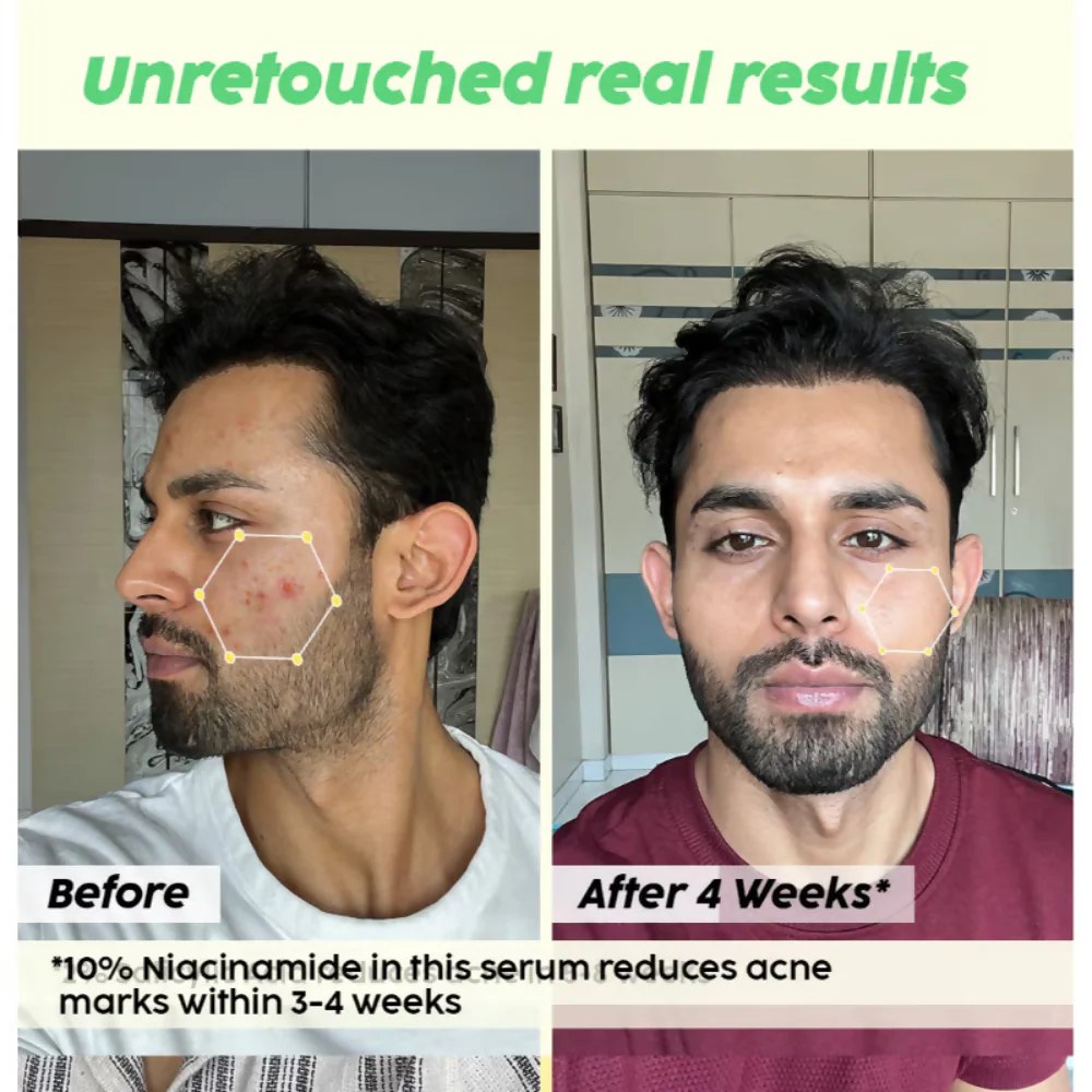 PLIX The Plant Fix 2% Acne Buster Moisturizer & 10% Niacinamide Serum - Image 11