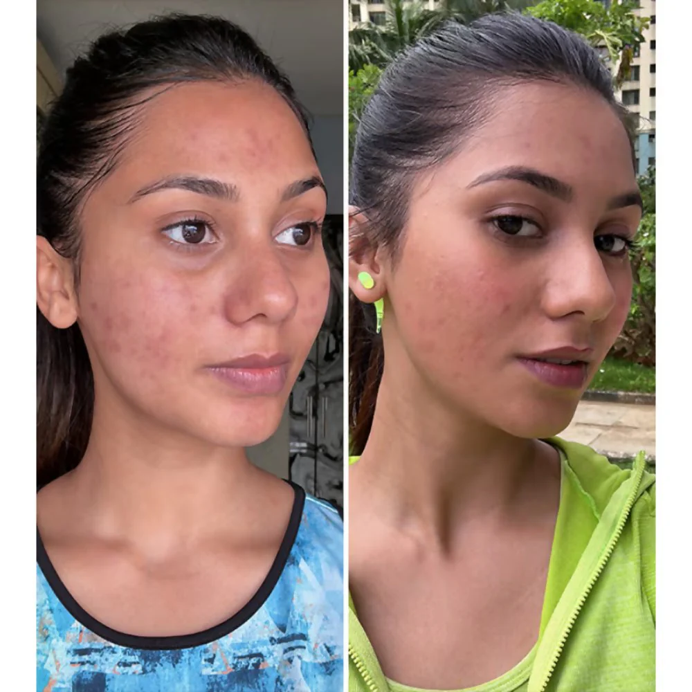 PLIX The Plant Fix 2% Acne Buster Moisturizer & 10% Niacinamide Serum - Image 8