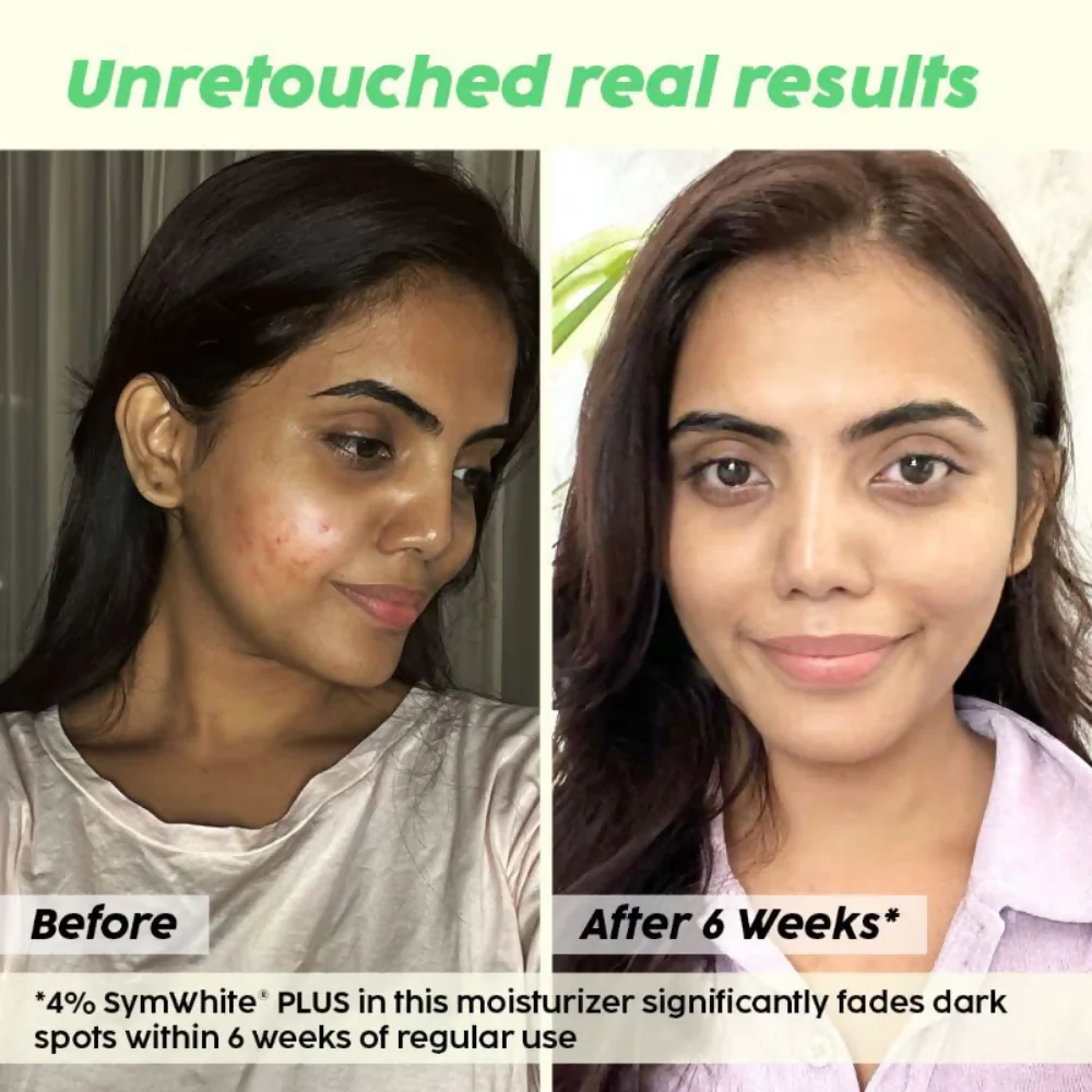 PLIX The Plant Fix 2% Alpha Arbutin Pineapple Moisturizer With SymWhite PLUS For Hyperpigmentation & Dark Spots - Image 5