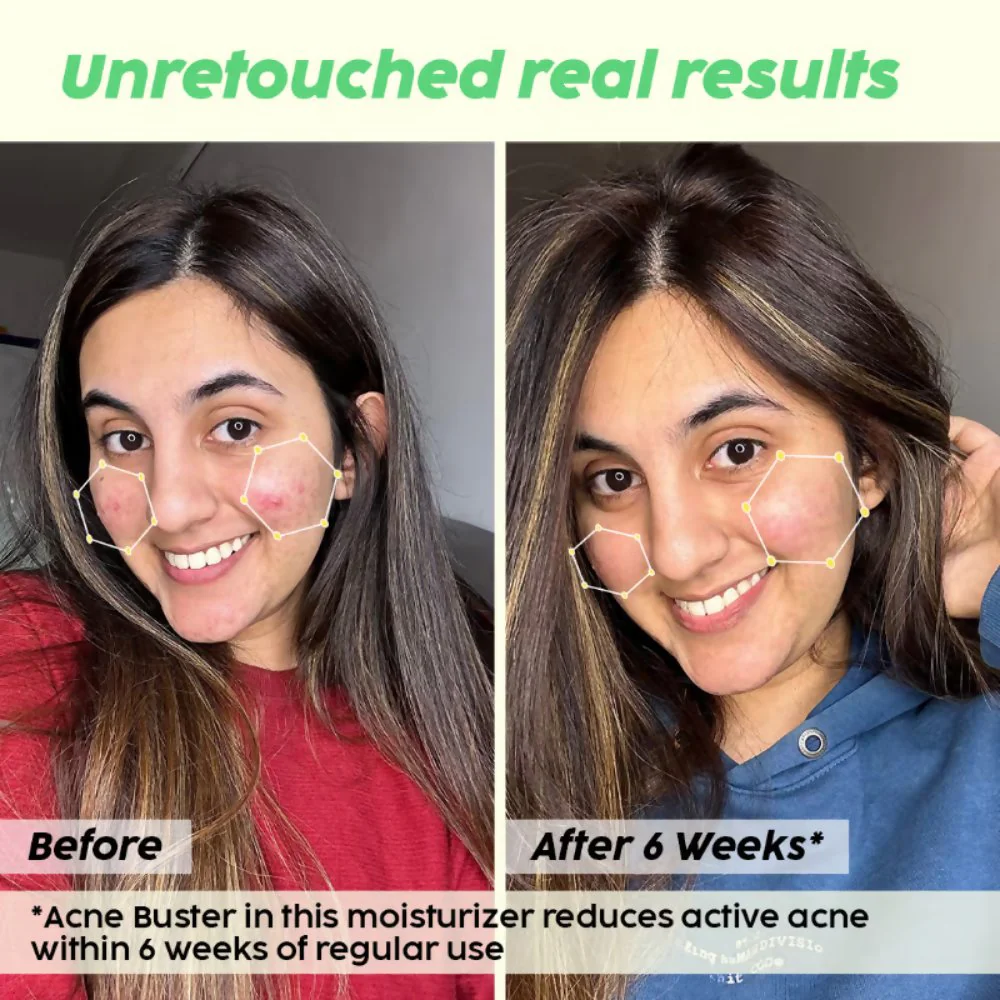 PLIX The Plant Fix 2% Salicylic Acid Active Acne Control Serum & Acne Buster Moisturizer Combo - Image 15