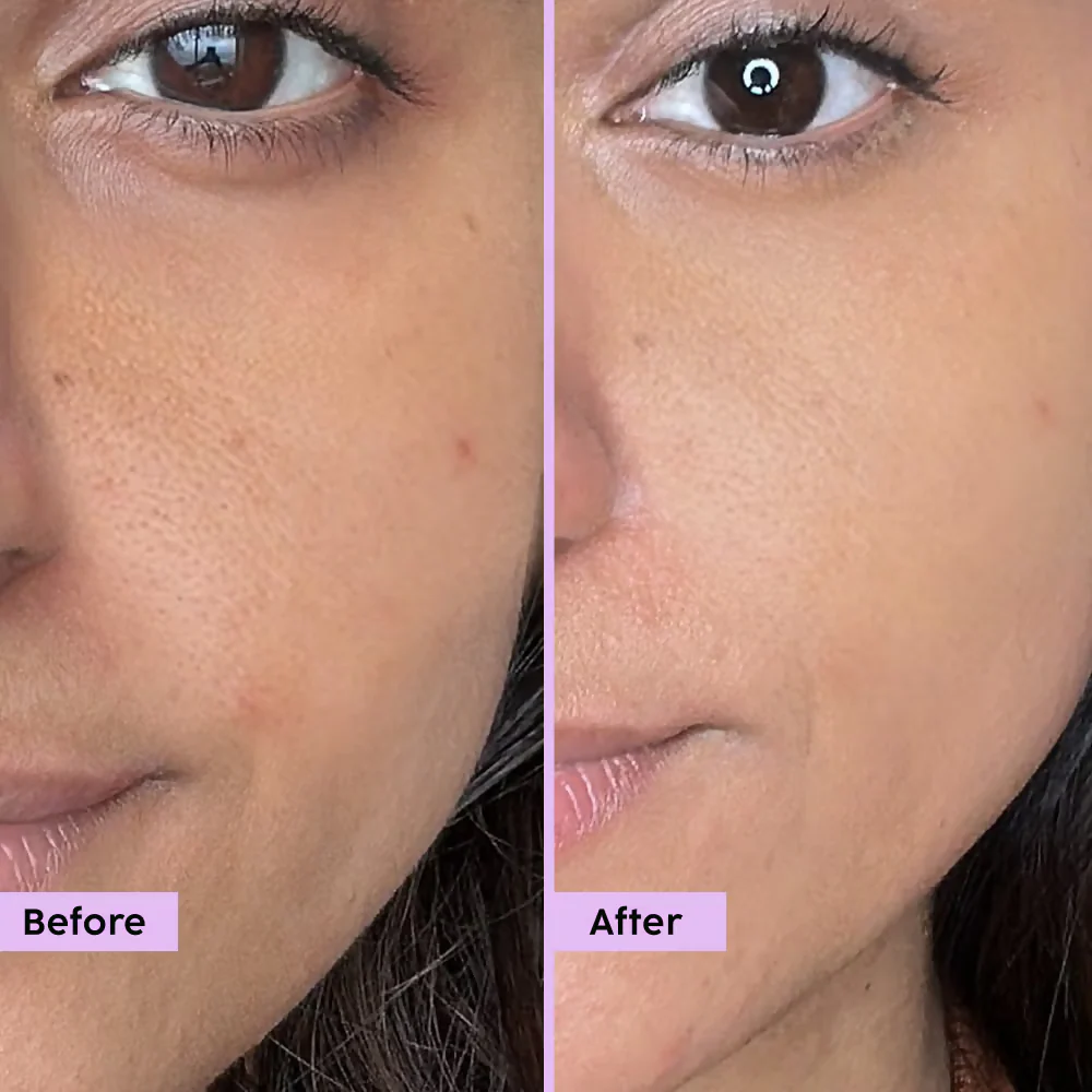PLIX The Plant Fix - Jamun Active Acne Regime With Cleanser & Toner To Unclog Pores & Reduce Acne - Image 9
